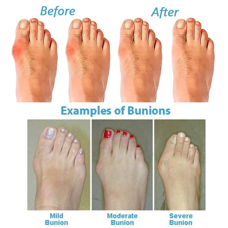 Suki Collection | Women's Sandals with Cushioned Support | Orthopedic Design for Bunion Relief and All-Day Comfort